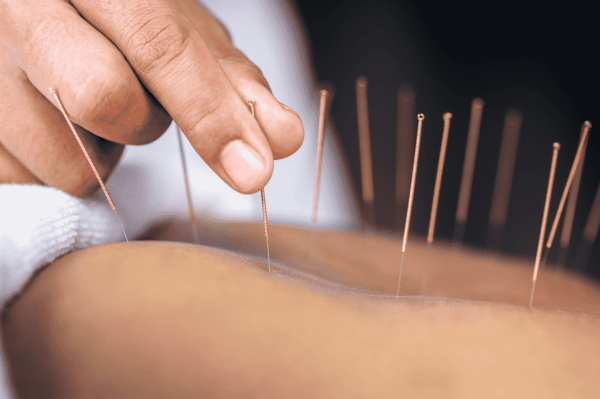How Acupuncture Supports Nerve Repair and Pain Management How Acupuncture Supports Nerve Repair and Pain Management