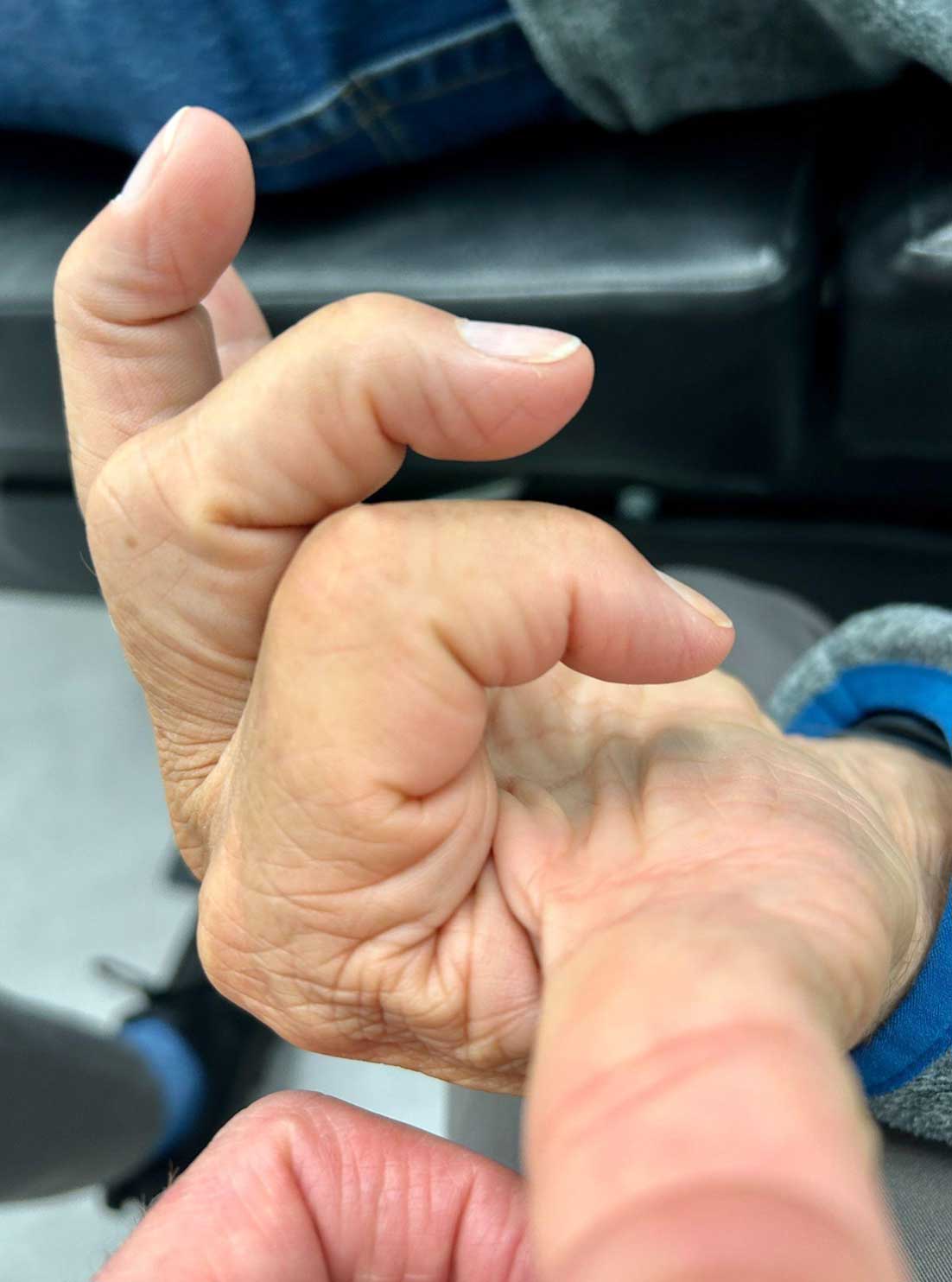 Patient Success Story - Finding Relief from Hand Arthritis with Class IV Laser - After
