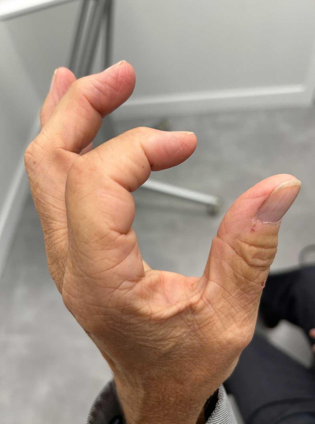 Patient Success Story - Finding Relief from Hand Arthritis with Class IV Laser - Before