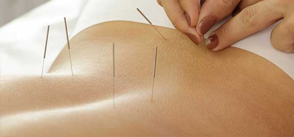 Acupuncture Services Tsawwassen Acupuncture Services Tsawwassen